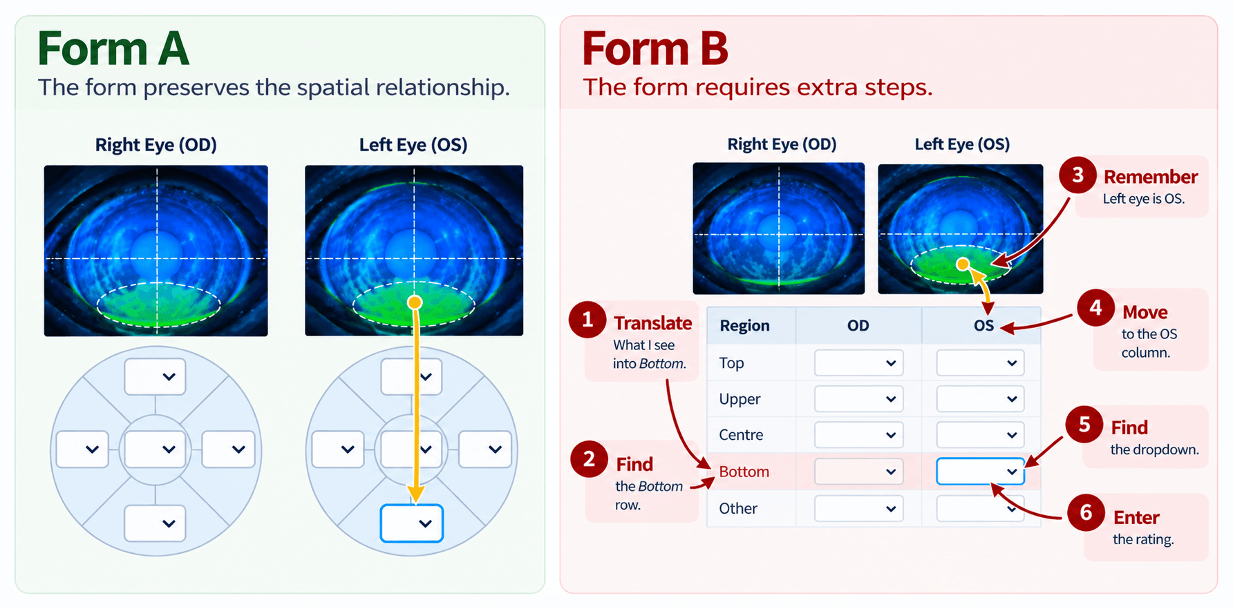 Side by side comparison. Form A preserves the spatial relationship: staining at the bottom of the left eye leads straight down to the field at the bottom of the matching diagram. Form B requires six numbered steps: translate what you see into Bottom, find the Bottom row, remember the left eye is OS, move to the OS column, find the dropdown, and enter the rating.